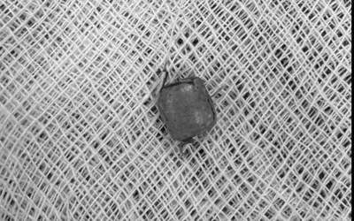 Bé 10 tuổi ù tai kéo dài, bác sĩ lấy ra thứ "đáng sợ" bên trong