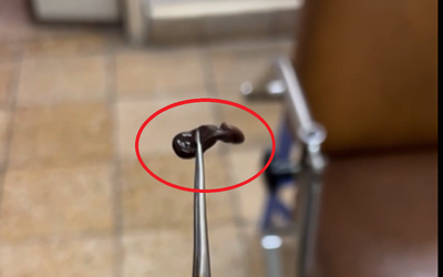 Bé trai 4 tuổi rỉ máu mũi kéo dài, bác sĩ gắp ra thứ "đáng sợ" bên trong