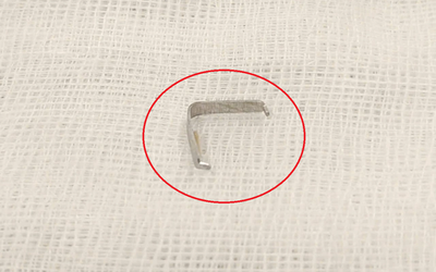 Bé trai 1 tuổi cứ ăn là nôn ọe, bác sĩ phát hiện "bí mật" bên trong