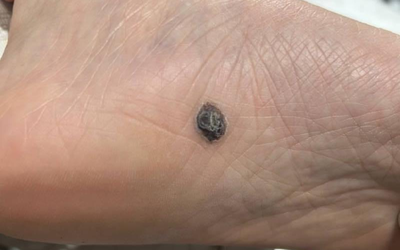 5 dấu hiệu nốt ruồi có thể là ung thư da, dấu hiệu số 1 dễ bị bỏ qua