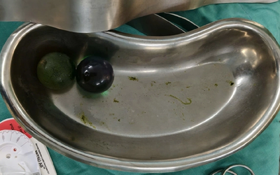 Bé gái 18 tháng tuổi nguy kịch, bác sĩ gắp ra thứ "đáng sợ" trong bụng