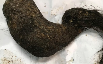 Bé trai bụng cứng như đá, bác sĩ choáng khi phát hiện "bí mật" bên trong