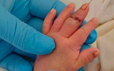 Nữ hộ sinh làm đứt ngón tay bé trai khi cắt dây rốn