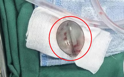 Bé 4 tuổi nôn ra máu, bác sĩ phát hiện thứ "đáng sợ" bên trong