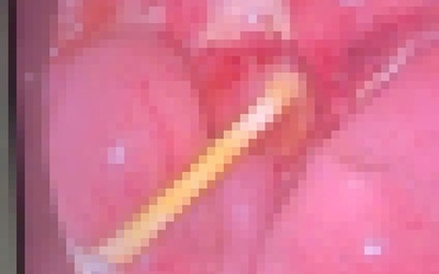 Bé 5 tuổi đau bụng kéo dài, gia đình sốc nặng khi bác sĩ gắp ra thứ "đáng sợ" trong bụng bé