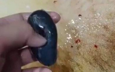 Nuốt mật cá sống để chữa đau đầu, người phụ nữ nhận kết đắng