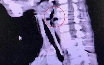 Bé trai 6 tuổi khò khè suốt nhiều tháng, bác sĩ gắp ra thứ "đáng sợ"