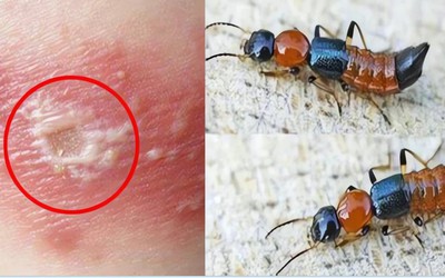 Kiến ba khoang "vào mùa", cẩn trọng dễ nhầm với zona thần kinh