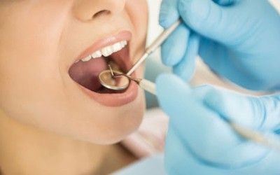 Lấy cao răng có được hưởng bảo hiểm y tế?