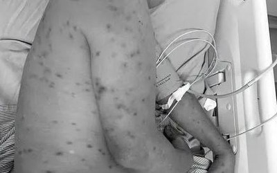 Bị hơn 300 con ong đốt, người đàn ông 62 tuổi nguy kịch