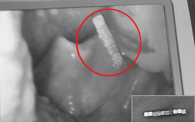 Bé trai gần 4 tuổi khó chịu ở cổ, bố mẹ kinh ngạc khi bác sĩ gắp ra thứ "đáng sợ" bên trong