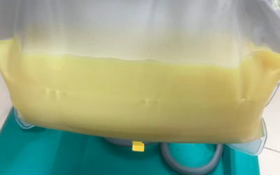 Người phụ nữ 32 tuổi máu "trắng đục như sữa", bác sĩ "chỉ mặt điểm tên" thói quen ít ai ngờ