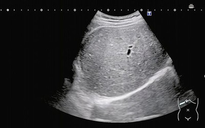 Người đàn ông 35 tuổi "gan trắng xóa" vì ngày nào cũng uống thứ nước "vạn người mê"