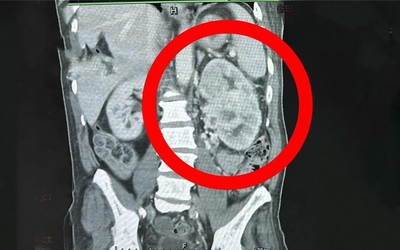 Có dấu hiệu này nhưng không đi khám, người đàn ông 64 tuổi mắc ung thư giai đoạn 4