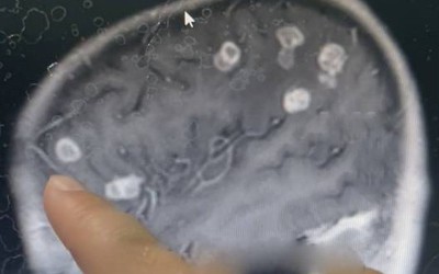 Bé gái sốt liên tục 17 ngày, bác sĩ sốc nặng khi phát hiện "bí mật" đáng sợ