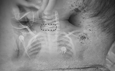 Bé trai bị sốt và co giật, bác sĩ phát hiện ra điều đáng sợ