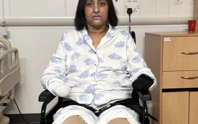 Bị chó cưng liếm, người phụ nữ "sốc" khi phải cắt cụt tay chân