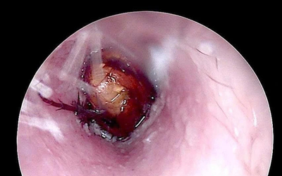 Cháu bé đau tai dữ dội, bác sĩ sốc ngang phát hiện bí mật "đáng sợ" bên trong