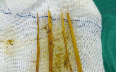 Cô gái 26 tuổi đau bụng dữ dội, bác sĩ “chết lặng” khi phát hiện thứ bên trong