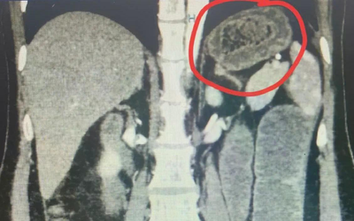 Người phụ nữ bụng "cứng như đá", bác sĩ sốc khi phát hiện bí mật "đáng sợ"