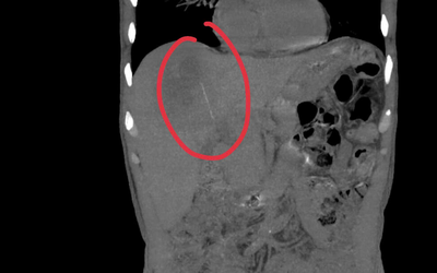 Người đàn ông đau bụng kéo dài, bác sĩ sốc khi phát hiện bí mật bên trong