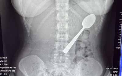 Đang ăn sữa chua, người phụ nữ nuốt chiếc thìa dài 17cm vào bụng