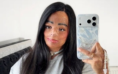 Dầu gội đầu bắt lửa, cô gái xinh đẹp bị bỏng nửa người và cái kết bất ngờ