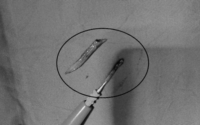 Người đàn ông 41 tuổi đau bụng, bác sĩ sốc phát hiện ra thứ đáng sợ "đi lạc" trong bụng