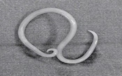 Thiếu niên 15 tuổi bị đau bụng thúc ngược lên, bác sĩ phát hiện "bí mật" đáng sợ bên trong