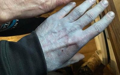 Toàn thân tím tái, người đàn ông vội đến bệnh viện và cái kết