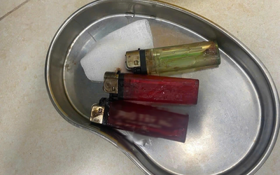 Bác sĩ sốc khi phát hiện 3 chiếc bật lửa trong bụng nam thanh niên