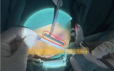 Bé trai đau mắt dữ dội, bác sĩ lấy ra thứ "đáng sợ" bên trong