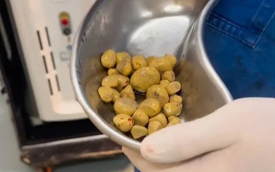 Bác sĩ sốc nặng khi lấy ra thứ đáng sợ trong cơ thể người đàn ông