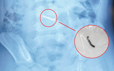 Bé trai 5 tuổi nuốt hàng chục viên nam châm gây thủng ruột