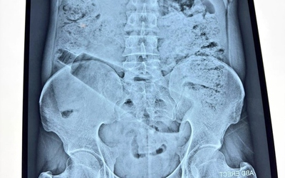 Người đàn ông đau bụng 36 tiếng, bác sĩ phát hiện "bí mật" bên trong