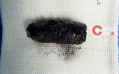 Mũi người đàn ông chảy dịch dai dẳng, bác sĩ phát hiện bí mật đáng sợ