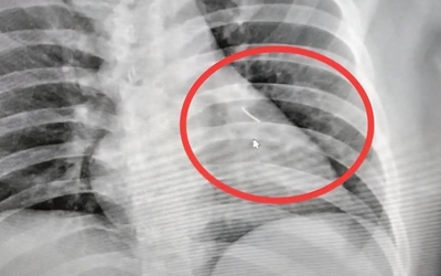 Người đàn ông bị đau ngực, bác sĩ sốc nặng khi phát hiện ra thứ bên trong