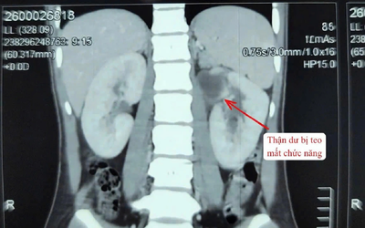 Kỳ lạ cô gái 22 tuổi có 3 quả thận