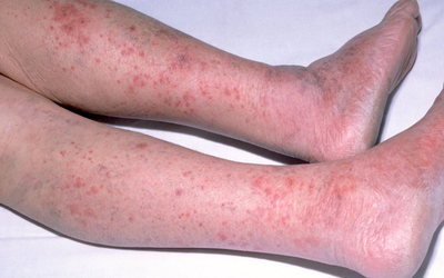 Căn bệnh là "sát thủ thầm lặng", người khỏe ngã gục chỉ trong 24 giờ: Bác sĩ chỉ cách phòng tránh