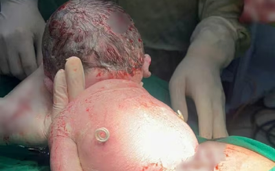 Bí ẩn em bé sinh ra với "đôi cánh nhỏ" trên lưng