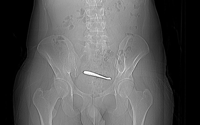 Người đàn ông đau bụng suốt 1 tuần, bác sĩ kiểm tra thì sốc nặng