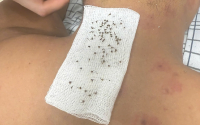 Hai bố ngất xỉu khi đi tìm tổ chim, đến viện bác sĩ chỉ ra nguyên nhân "đáng sợ"