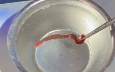 Người đàn ông 53 tuổi chảy máu mũi liên tục, bác sĩ phát hiện ra thứ "đáng sợ" ẩn náu bên trong