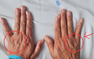 Tê ngón tay út tưởng chuyện nhỏ, người đàn ông 51 tuổi suýt bị teo cả bàn tay