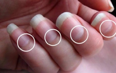 7 dấu hiệu bất thường ở móng tay có thể “tố cáo” bệnh tim, phổi, thận, tuyến giáp
