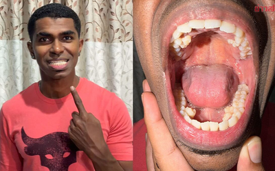 Tưởng mọc răng “bất thường”, chàng trai đi khám và phát hiện mình nắm kỷ lục hiếm có