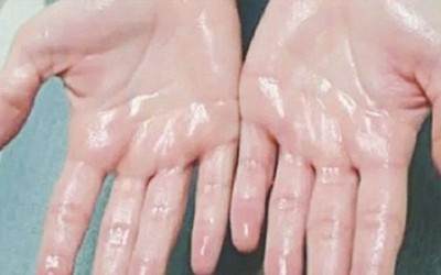 Cách kiểm soát tình trạng ra mồ hôi tay hiệu quả bậc nhất