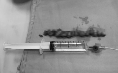 Đau lưng kéo dài tưởng xương khớp, người phụ nữ tá hỏa khi biết mình mắc bệnh nguy hiểm