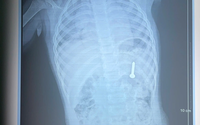 Đang chơi ở nhà, bé gần 2 tuổi nuốt phải thứ "đáng sợ"