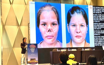 Giải pháp điều trị biến chứng sau nâng mũi gây chú ý tại Hội nghị thẩm mỹ quốc tế APS Korea 2026